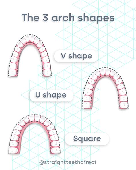 Arch Expansion in Orthodontics: What is it?