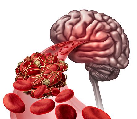 What causes blood clots in the brain?