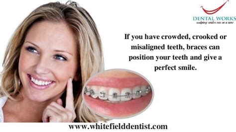 Orthodontic Braces In Bangalore | Misaligned Teeth Treatment In India