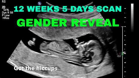 12 weeks 5 days Ultrasound/ GENDER REVEAL - YouTube