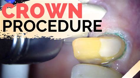 Dental Crown Explained | Anterior Crown Preparation - YouTube