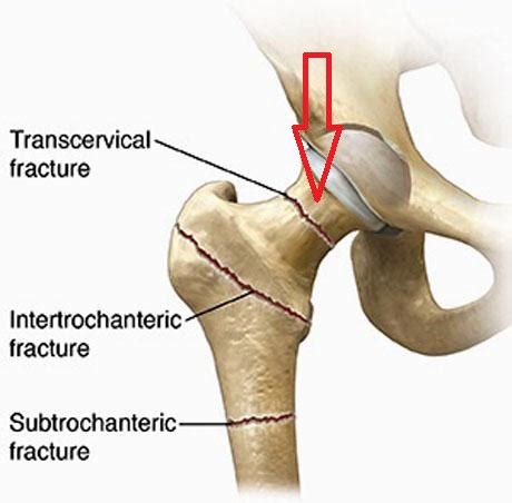 FEMORAL NECK FRACTURE | GEORGE D. GOUDELIS MD. Ph.D.