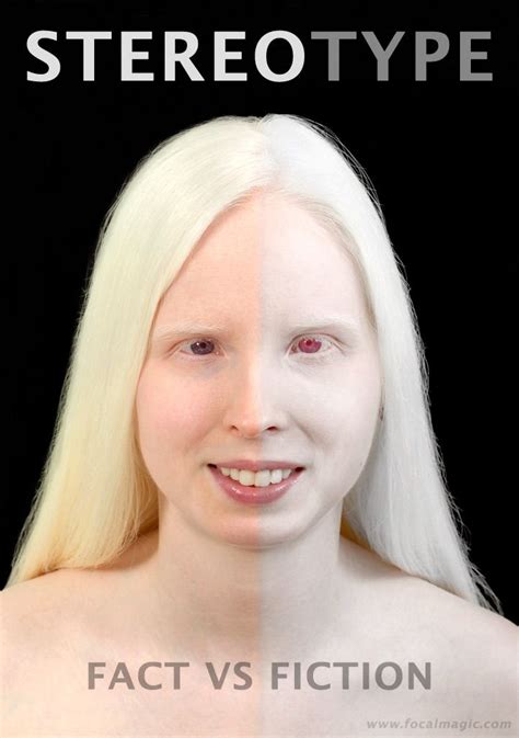 Albinism by Kate Bagwell and Catherine | Albinism, Violet eyes, Light eyes