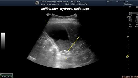 Gallbladder Ultrasound