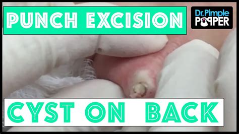 A Perfect Cyst Removal With A Punch, 42% OFF