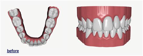 Byte Invisible Aligners Cost and Review | POPSUGAR Beauty