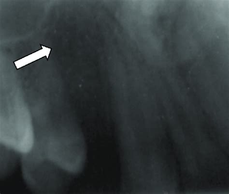 Follow-up intraoral periapical showing new bone formation | Download Scientific Diagram