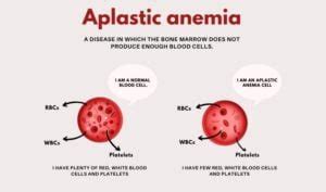 Aplastic Anemia Treatment in Delhi A Comprehensive Guide