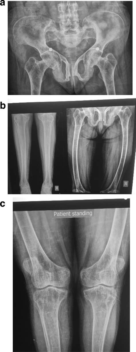 a Pelvic X-ray. Osteopenia around hip joints. Abnormal shaped pelvic... | Download Scientific ...