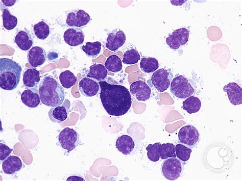 Follicular lymphoma–bone marrow aspirate - 2.