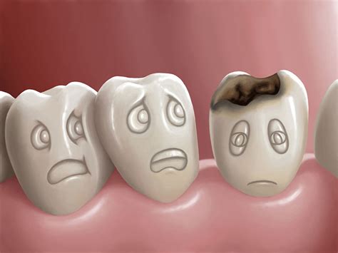 How To Prevent Teeth Decay And Tooth Damage | Dental Sanctuary