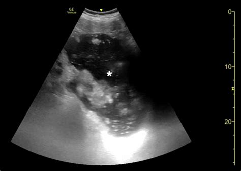 Cureus | Emergency Physician-Performed Bedside Ultrasound of Gastric Volvulus