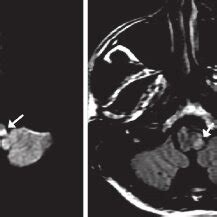 (PDF) Wallenberg Syndrome following neck cracking: A case report