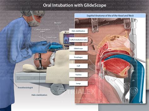 Oral Intubation with GlideScope - TrialExhibits Inc.