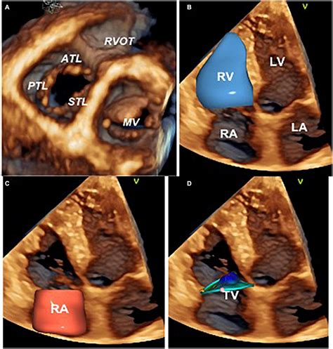 Three-dimensional echocardiography assessment of the tricuspid valve,... | Download Scientific ...