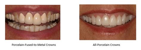 All-Ceramic Versus Porcelain Fused to Metal - Kentucky Dental Group