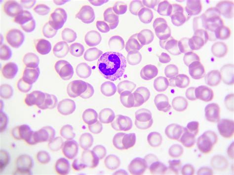 What is a band neutrophil? • The Blood Project