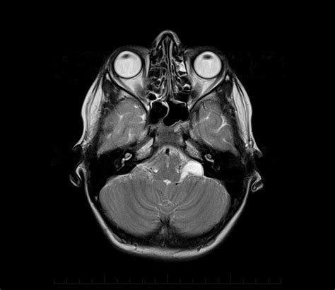 25++ Pineal Gland Cyst Mri | Muldede