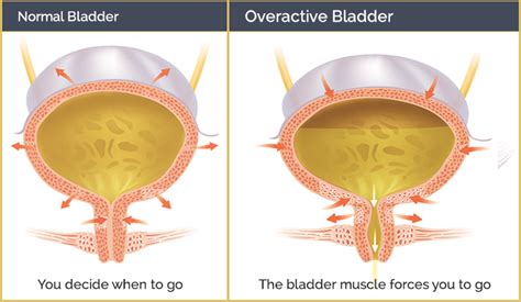 Overactive Bladder | Star Clinic