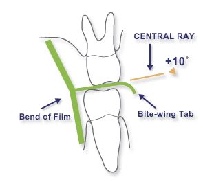 Intraoral Radiographic Techniques (Bitewing Radiography)-Chapter 4 ...