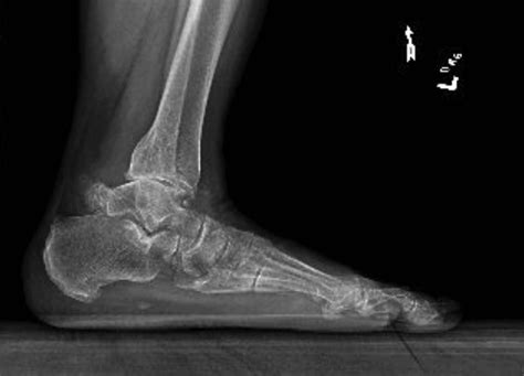 Chronic Ankle Pain? Put Os Trigonum Fracture in the Differential ...