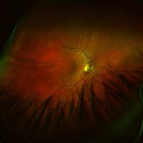 Is sickle cell retinopathy dangerous | Eye Disorders and Diseases articles | Body & Health ...