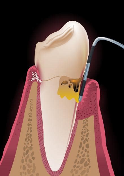 Periodontitis Gum Disease