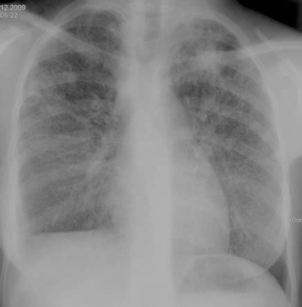 Progressive primary tuberculosis | Radiology Case | Radiopaedia.org