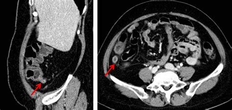 Acute appendicitis – Radiology Cases