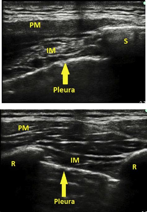 A) Ultrasound transversal view of the intercostal space. To perform ...