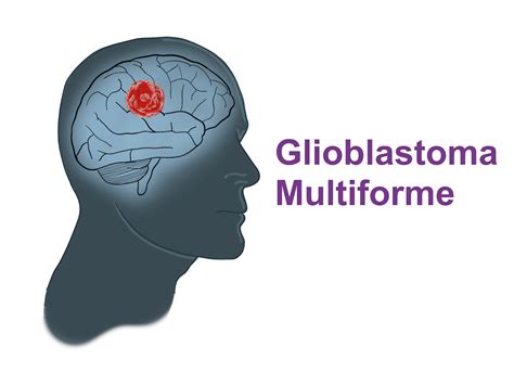 Glioblastoma Multiforme: the deadliest brain tumor - Pro doctor