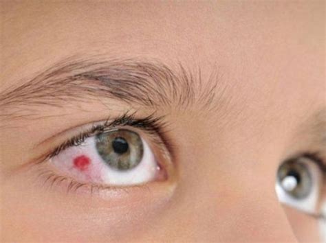 Blood in the eye: What to do, causes and remedies – From Doctor