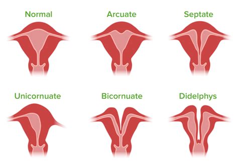 Congenital Malformations of the Female Reproductive System | Concise ...