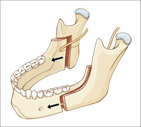 Mandibular Osteotomies and Distraction Osteogenesis: Evolution and Current Advances: JAMA Facial ...