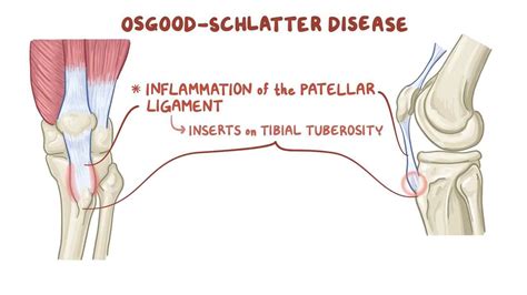 Osgood-Schlatter disease (traction apophysitis) - Osmosis