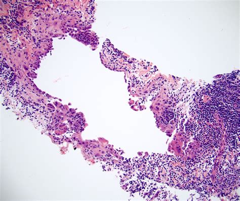 Mesothelial Cells