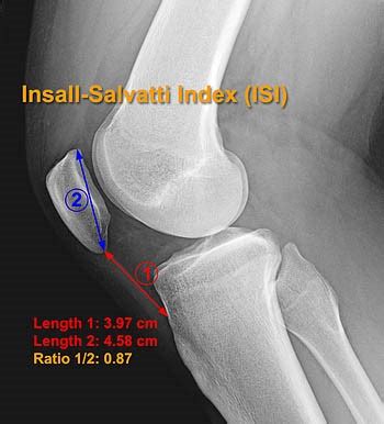 Icd 10 For Patellofemoral Syndrome - Pregnancy Depression