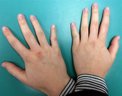 Unusual Clinodactyly | Congenital Hand and Arm Differences