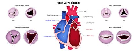 Heart Valve Replacement - Understanding Heart Valve Diseases and Treatment Options | Meril