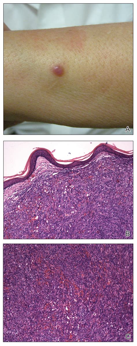 Kaposi Sarcoma Rash