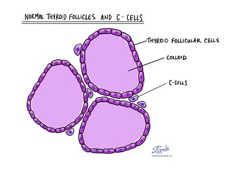 Medullary thyroid carcinoma - MyPathologyReport.ca