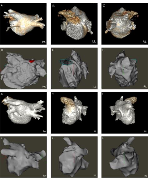 Three-Dimensional Modeling of the Left Atrium and Pulmonary Veins with a Precise Intracardiac ...