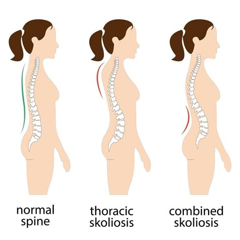 Spine deformation types and healthy spine comparison diagram poster with backbone curvatures ...