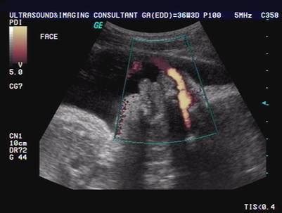 Macroglossia