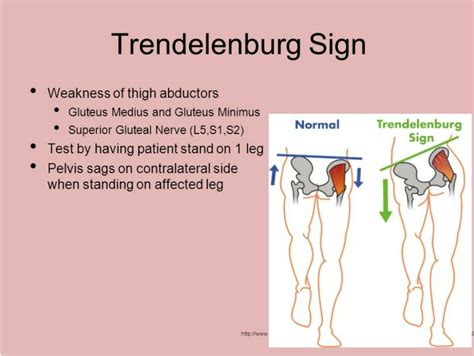 Trendelenburg sign - d/t weakness of abductors... #gait ( Correction ...