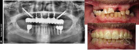 Zygomatic Implants in Burbank | Ramsey Amin, DDS