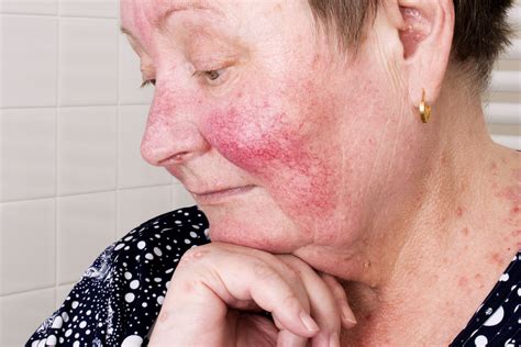 Rosacea Definition, Facts, Causes, and Treatments