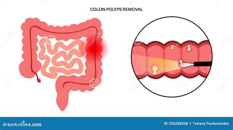 Colon polyps inflammation stock vector. Illustration of medicine - 250288508