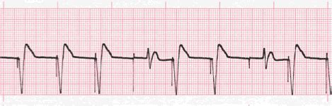 Pacemaker Rhythm ECGs