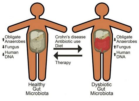 Symptoms of Crohn’s disease and what you should do about it - TWB